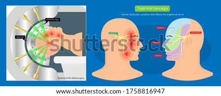 Trigeminal neuralgia chronic pain of facial TMD injury ophthalmic maxillary mandibular sensation central nervous system immune attacks myelin