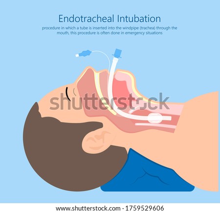 Endotracheal intubation ICU care unit COVID 19 larynx  throat rescue surgery mouth Tube trachea breathe ventilation deliver oxygen lungs insert sedate rest airway foreign body removal block aspiration