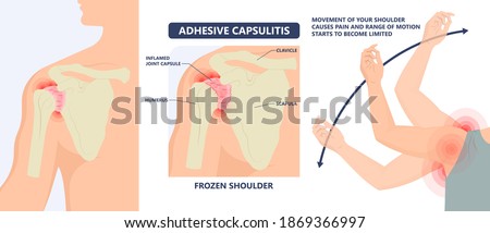 Frozen shoulder adhesive capsulitis surgery stiff crush ribs bone lift athletes arm rupture symptom freezing stiffness rheumatoid arthritis swelling of