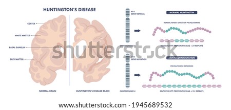 Huntington parkinson Motor alzheimer neuron brain DNA gene nerve cell juvenile problem defect genetic basal ganglia neuro repeat mutant damage testing defective mood inherits system family memory loss