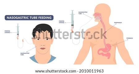TPN PPN Total tube nutritional partial line PICC IV care unit ICU tract enteral gavage nose PEG stomach surgery system small nose large food cancer eat NG bowel PEJ pump Foto stock © 