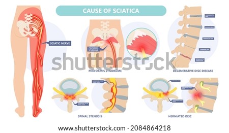 Sciatica nerve pain lower back through hips to leg