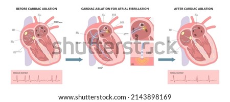 Cardiac catheter ablation Atrial fibrillation minimally invasive procedure rhythm problem cath lab treat treatment Coronary x-ray Radio frequency Sinus Ventricular SVT ECG ICD Radiofrequency attack
