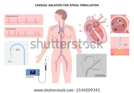Cardiac catheter ablation Atrial fibrillation minimally invasive procedure rhythm problem cath lab treat treatment Coronary x-ray Radio frequency Sinus Ventricular SVT ECG ICD Radiofrequency attack Сток-фото © 