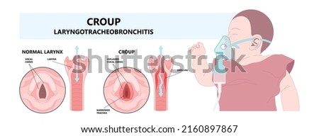 Croup upper airway obstruct virus voice box vocal cord tube swollen noise baby child cold flu sick stuffy runny nose fever common kids lung covid 19 RSV tract high pitched Photo stock © 
