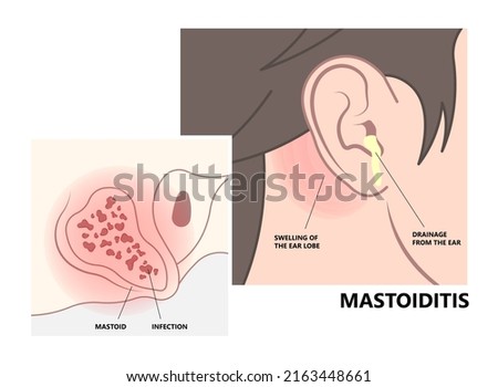 Perforated eardrum tube surgical drain Otitis media ear wax Hole repair sound canal tear pain pus bloody Hearing loss injury Middle fluid water Loud blasts microscopic acute bone cotton swab otoscopic Imagine de stoc © 