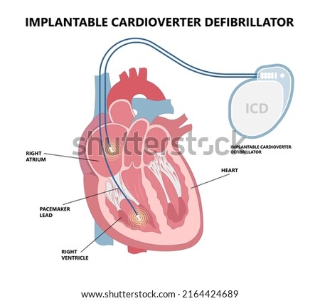 Pacemaker ICD Implantable Cardioverte Defibrillator Pulse Generator Stimulate of Heart Prevent Bradycardia Electronic Medical Device