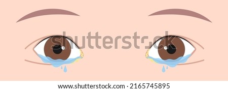 Blocked tear duct eye sinus toddler red dry swollen nasal nose pain eyelid Gland medial system drain sac birth baby child obstruct tumor polyps pink Mucus Eyedrop glaucoma Dacryolith disease