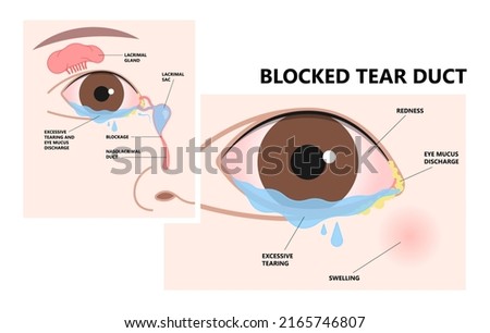 Blocked tear duct eye sinus toddler red dry swollen nasal nose pain eyelid Gland medial system drain sac birth baby child obstruct tumor polyps pink Mucus Eyedrop glaucoma Dacryolith disease Photo stock © 
