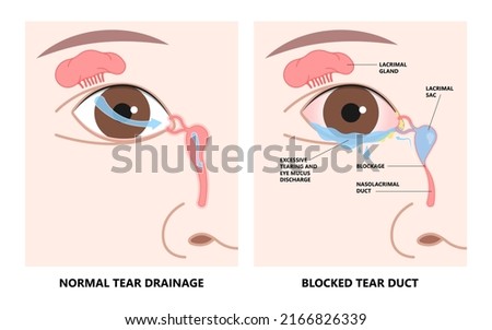 Blocked tear duct eye sinus toddler red dry swollen nasal nose pain eyelid Gland medial system drain sac birth baby child obstruct tumor polyps pink Mucus Eyedrop glaucoma Dacryolith disease