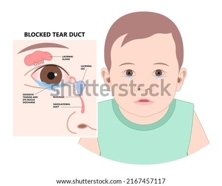 Blocked tear duct eye sinus toddler red dry swollen nasal nose pain eyelid Gland medial system drain sac birth baby child obstruct tumor polyps pink Mucus Eyedrop glaucoma Dacryolith disease Photo stock © 