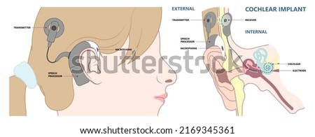 hearing aid ear child deaf signal baby inner middle bone loss outer canal birth meniere's cochlea brain implantation test exam