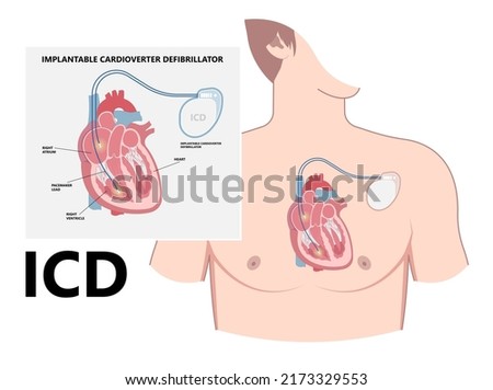 Pacemaker ICD Implantable Cardioverte Defibrillator Pulse Generator Stimulate of Heart Prevent Bradycardia Electronic Medical Device