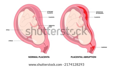 vasa previa fetal infant baby born c section nuchal cord twins fetus defect vessels funic labor growth low lying birth fluid of PROM test increta cervix Bilobed sac uterus neck knotted Contraction