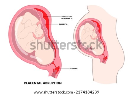 vasa previa fetal infant baby born c section nuchal cord twins fetus defect vessels funic labor growth low lying birth fluid of PROM test increta cervix Bilobed sac uterus neck knotted Contraction
