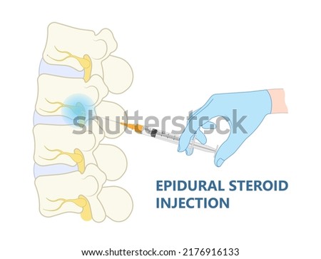 lower back hip pain Bone lumbar canal physical therapy spurs local neck disk neural hernia heavy Paget’s facet space good poor bad root anti inflammatory drugs neural spine cord nerve block anatomy