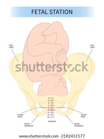 Labor C section praevia Mother twins cord hip lie bone fetal Baby born Head Down canal Left womb Right spine pelvis cervix score birth Breech defect vertex Exam uterus Frank Bishop weeks Infant