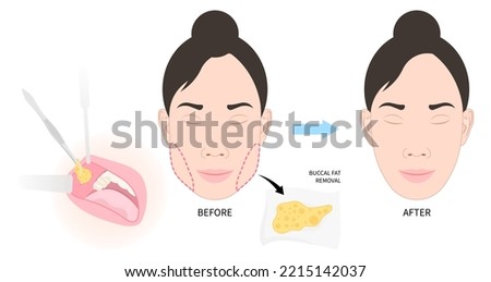Cheek buccal fat removal and augment excess slim face of Bichat’s procedure