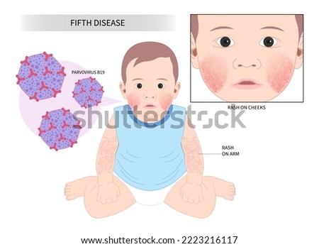 Fifth disease facial reaction slapped cheek child toddler human herpes viral with NICU Neonatal Intensive Care Unit Stock fotó © 