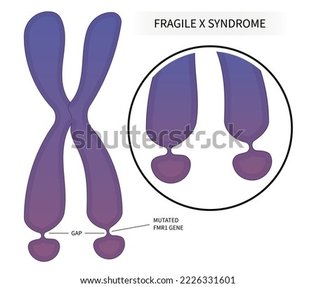 DNA disorder testing of Fragile x syndrome with ADHD and for elongated face flat feet protruding ears inherited health depression forehead disability prominent jaw