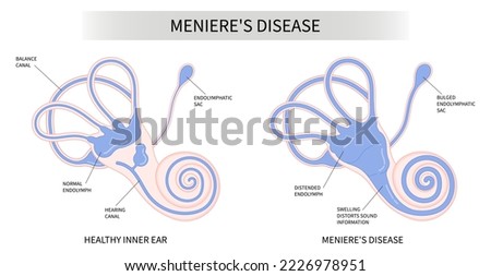 The Meniere's disease of sound in stuffy ear hear ringing roaring buzzing loss of balance dizzy spells pressure headache