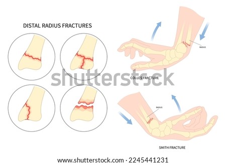 Anatomy hand radial dislocated avascular necrosis displacement break painful fall onto an outstretched closed fragment of dorsal Ulna Extra Intra articular and De quervain's proximal by car pole