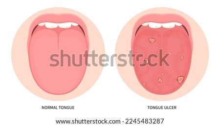 Canker sore trauma in mouth cancer ulcer swelling oral inflamed pain angular viral pink burnt throat tonsils gums dry of hunter median celiac iron virus fungal B12 anemia immune system red fever