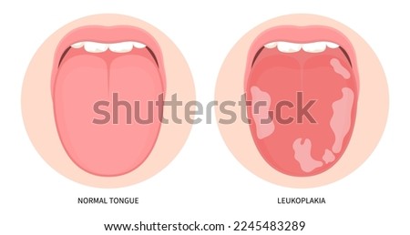 White fungal inflamed in mouth cancer ulcer swelling oral pain angular canker sore viral pink trauma burnt throat tonsils gums dry of hunter median celiac iron virus B12 anemia immune system red fever