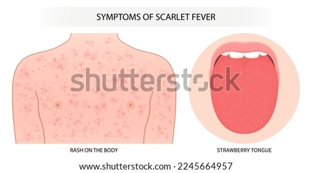 Sunburn body neck trunk children and tongue bacterial Infectious kidney red swelling lines face Flushed group a toxin sore
