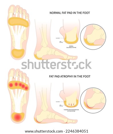 Painful heel bone spurs in Plantar fat pad atrophy tear high ankle shoes feet sport fascia arch of Lupus shots steroid for Achilles tendon