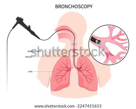 Bronchioles tumor cancer malignant cell surgical with flexible fiber optic guided medical chest X RAY test lymph node masses chronic asthma mucus plug bronchi washing