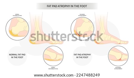Plantar fat pad atrophy painful high heel ankle shoes bone spurs feet sport fascia arch of Lupus shots Steroid tear Achilles tendon