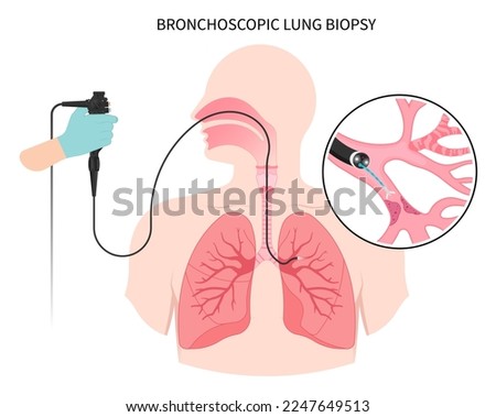 Medical bronchi washing for chronic asthma mucus plug Bronchioles tumor cancer malignant cell surgical with flexible fiber optic guided chest X RAY test lymph node masses