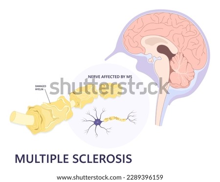 Multiple Sclerosis Amyotrophic lateral sclerosis myasthenia gravis systemic Guillain barre syndrome transverse demyelinating myelitis Parkinson's disease