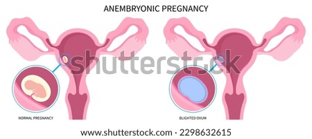 pregnancy loss missed abortion with Blighted ovum of anembryonic ectopic empty egg molar conception fertilization miscarriage and early first Natural
