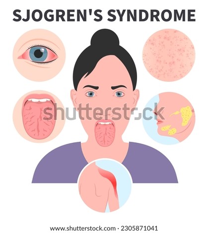 Sjogren's Syndrome dry eye Lymph nodes redness saliva sialadenitis Intraoral halitosis Burning Fissured Difficulty swallowing Fissured throat skin Cracked sore tongue