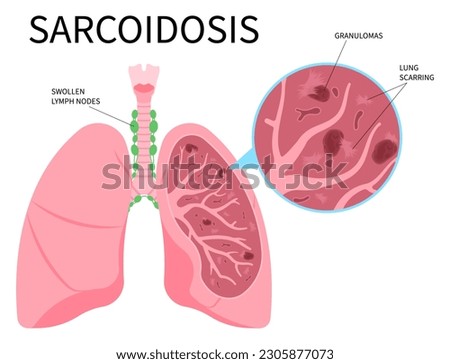 Lung cancer lupus pulmonary fibrosis Sarcoidosis and granuloma amyloidosis tuberculosis of skin eye lymph node uveitis with pernio systemic inflammatory