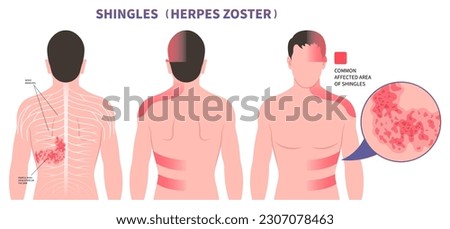 Area that the varicella chickenpox pain on body and skin itching rash Shingles Herpes Zoster virus blister sores of torso Vaccine