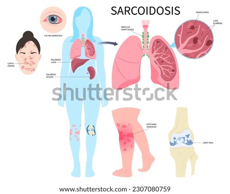 Pulmonary fibrosis and Lung cancer lupus Sarcoidosis granuloma amyloidosis tuberculosis of skin eye lymph node uveitis with pernio systemic inflammatory