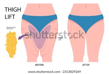 cosmetic weight loss Thigh lift or Thighplasty leg bariatric surgery with body hip Liposuction cellulite reducing contour of mass Index and BMI removal