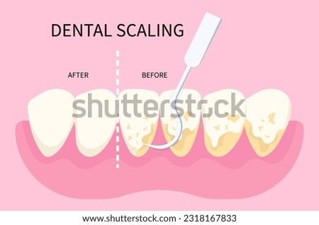 Dental scaling for toothache in dentistry with abfraction disease of teeth fracture crack broken and Bad breath grinding pain syndrome