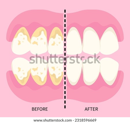 Before and after of dental scaling for toothache in dentistry with abfraction disease the teeth fracture crack broken with Bad breath grinding pain syndrome