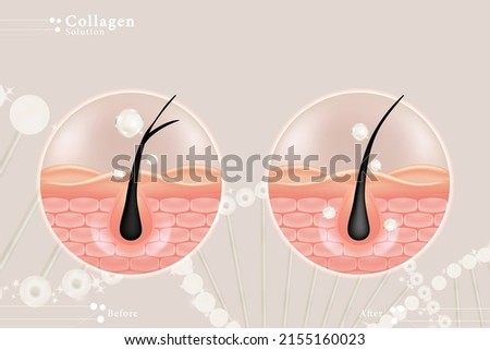 Hyaluronic acid before and after hair and skin solutions ad. White collagen serum drop over skin cells with cosmetic advertising background ready to use, illustration vector.	