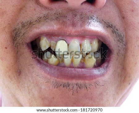 dirty teeth in the Mouth.,Unattractive teeth,denture