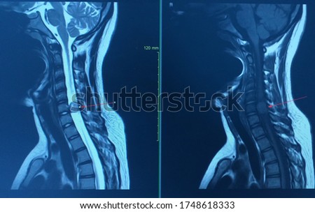 MRI CERVICAL SPINE HISTORY A 16 year old female presented with progressive and paresthesia of the leg for 2 month.Finding a lage mass in the enlarged right C6-7 neural foramen and extending to Rt.side Stok fotoğraf © 