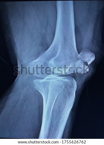 Film x-ray left knee joint lateral view Displaced fracture kneecap(patella) No joint dislocation.Medical healthcare concept. Сток-фото © 