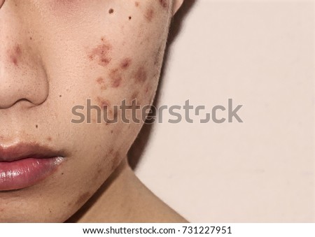 Acne Images - Download Free Images