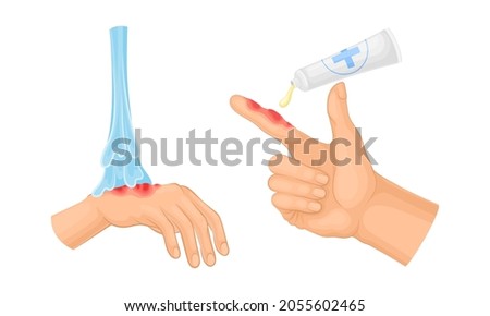 Skin burn injury treatment. First aid for burn wound vector illustration 商業照片 © 