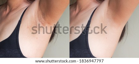 Image before and after skincare cosmetology armpits epilation treatment concept. Problem underarm chicken skin, Fox Fordyce, black armpit in woman. 
