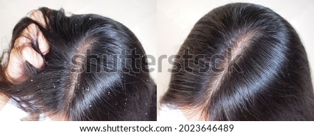 Image before and after anti dandruff treatment shampoo on hair woman.Problem health care concept.
